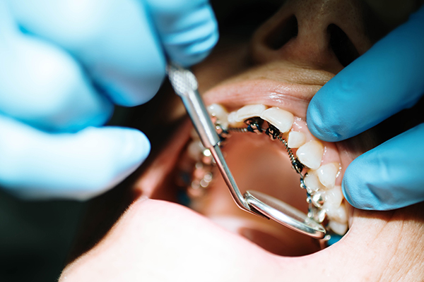 ortodoncia lingual tratamiento brackets interiores