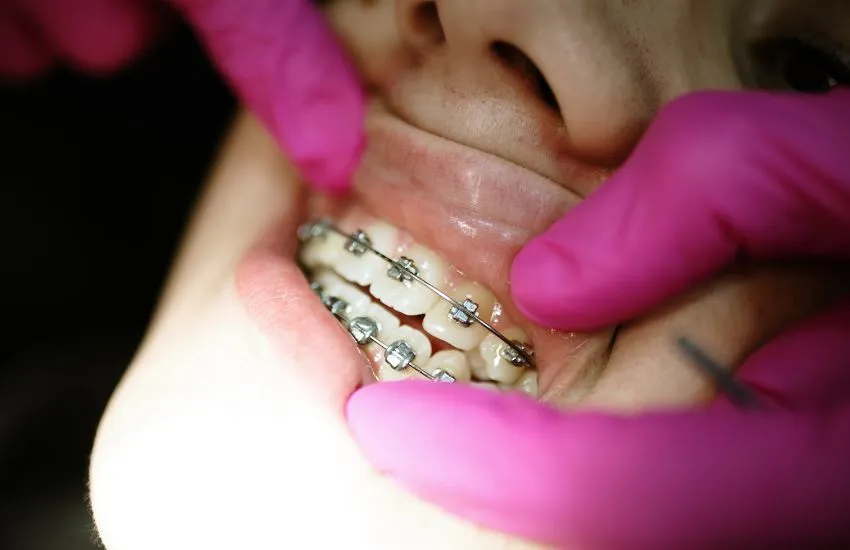 Cures d'higiene oral amb brackets