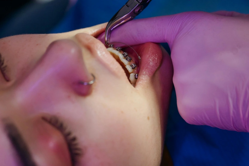 Cuando es necesario el ajuste de brackets