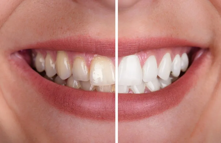 anteniment post blanquejament dental guia completa