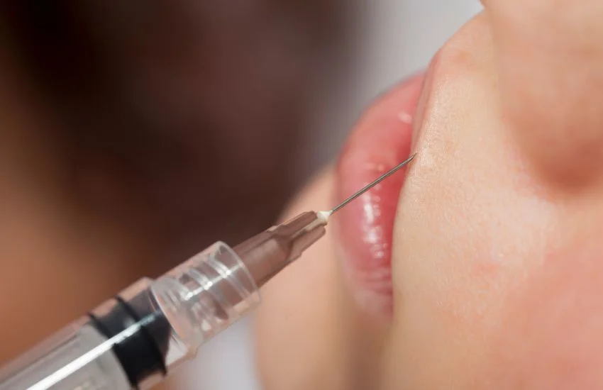 Mano con jeringa junto al labio, preparación para un tratamiento estético de ácido hialurónico.